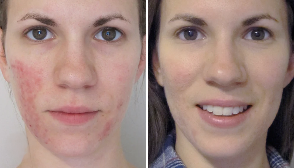 Rosacea Corrector | 1+1 FREE