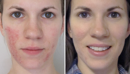 Rosacea Corrector | 1+1 FREE