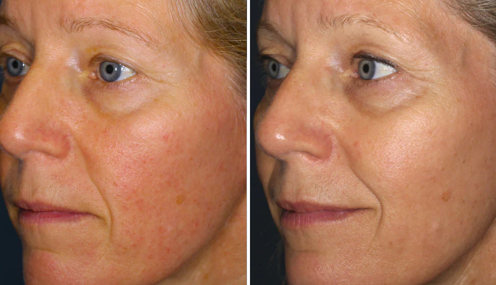 Rosacea Corrector | 1+1 FREE