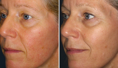 Rosacea Corrector | 1+1 FREE