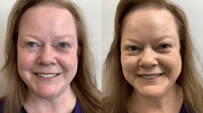 Rosacea Corrector | 1+1 FREE