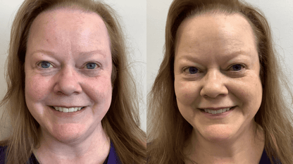 Rosacea Corrector | 1+1 FREE