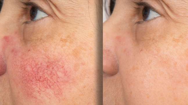 Rosacea Corrector | 1+1 FREE