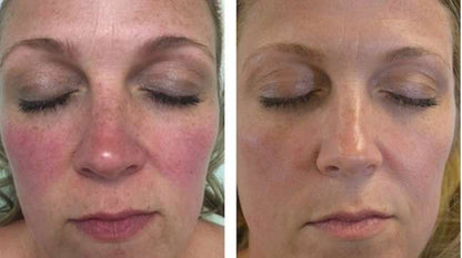 Rosacea Corrector | 1+1 FREE