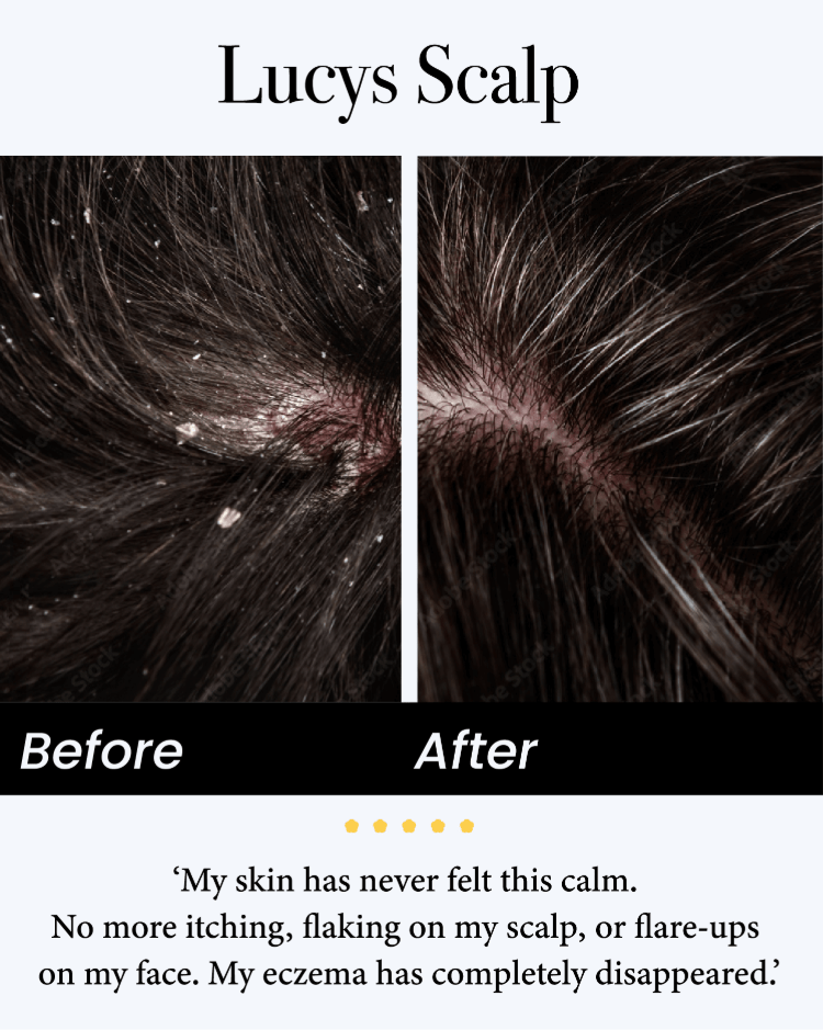 🔥 Flash Sale ⏳ Scalp Treatment Serum ✨ Dandruff Relief • Hair Fall Control • Oil Balance 💧 Stronger Hair • Healthier Scalp • Visible Results in Weeks 💪