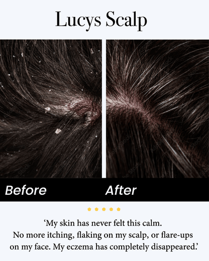 🔥 Flash Sale ⏳ Scalp Treatment Serum ✨ Dandruff Relief • Hair Fall Control • Oil Balance 💧 Stronger Hair • Healthier Scalp • Visible Results in Weeks 💪